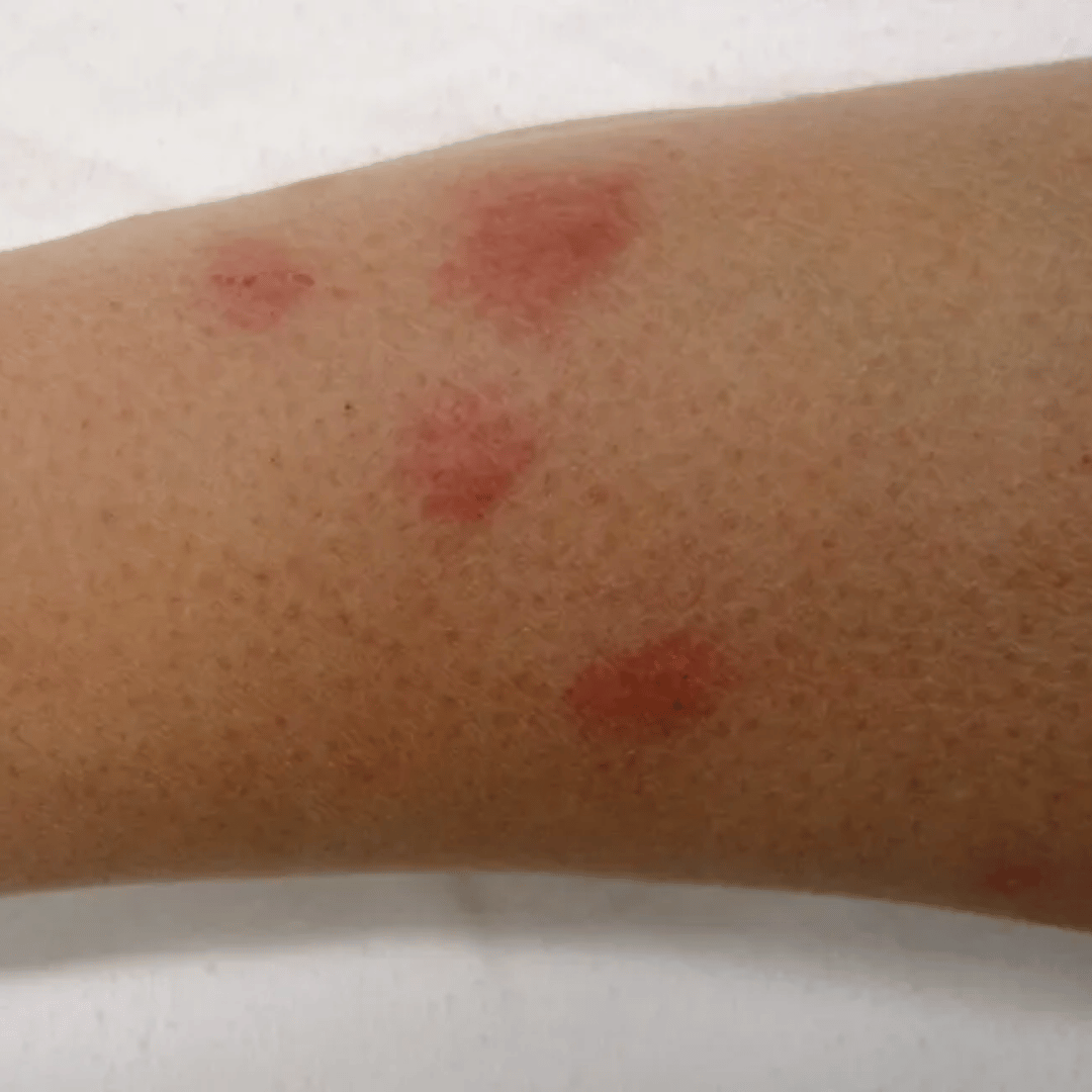 picture showing bed bugs bite human hide