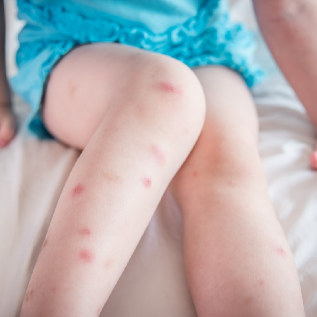 picture showing cockrochs bite on baby girl leg